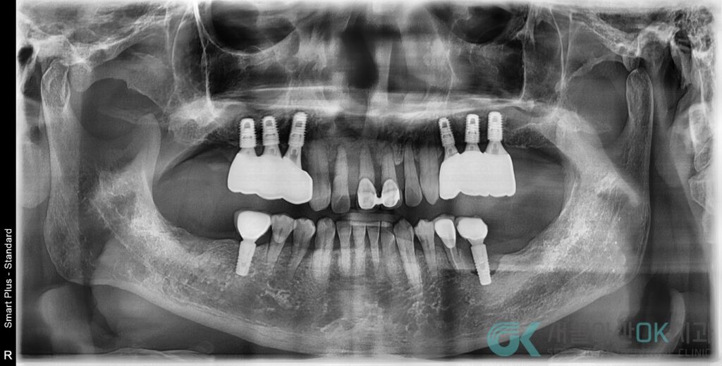 하남미사임플란트 치과, 잇몸이 약해도 임플란트치료가 가능한 이유 2