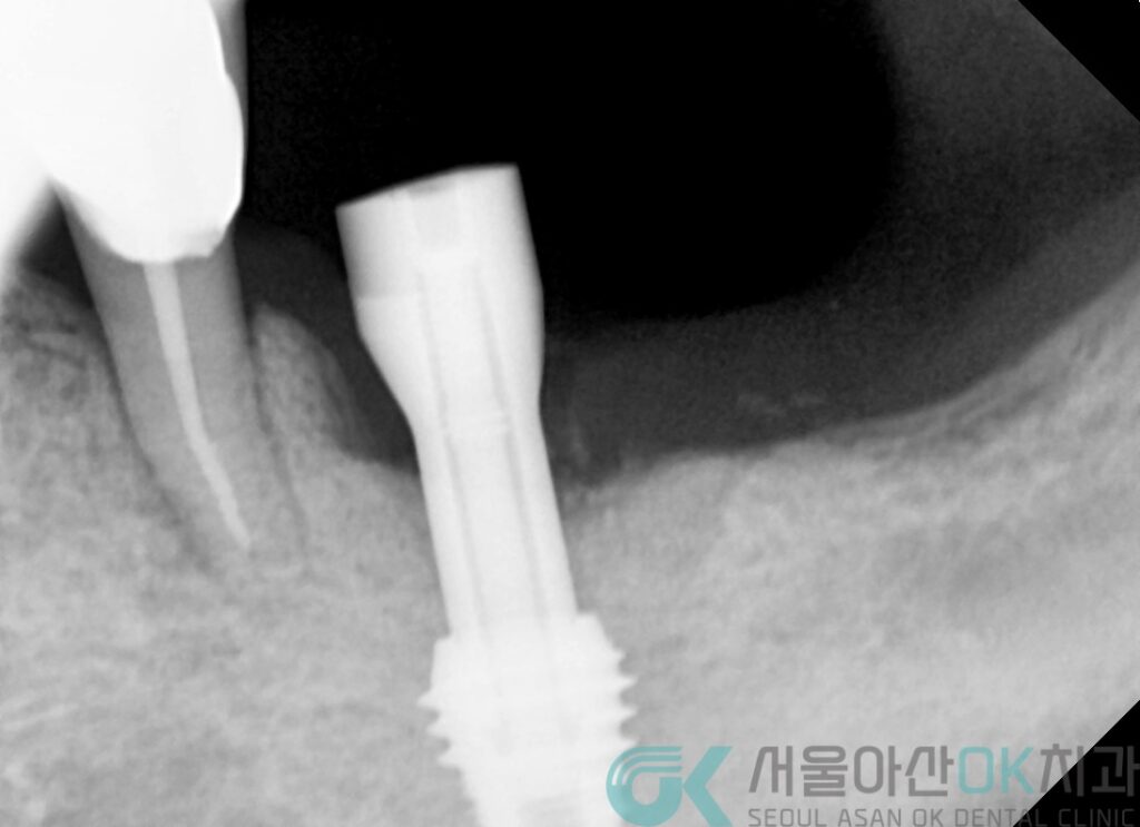 하남미사임플란트 치과, 잇몸이 약해도 임플란트치료가 가능한 이유 3