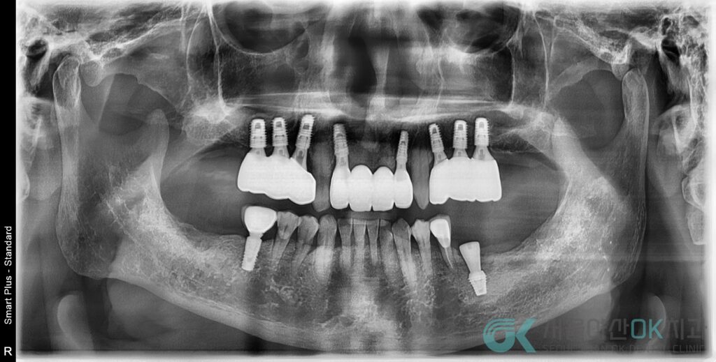 하남미사임플란트 치과, 잇몸이 약해도 임플란트치료가 가능한 이유 4