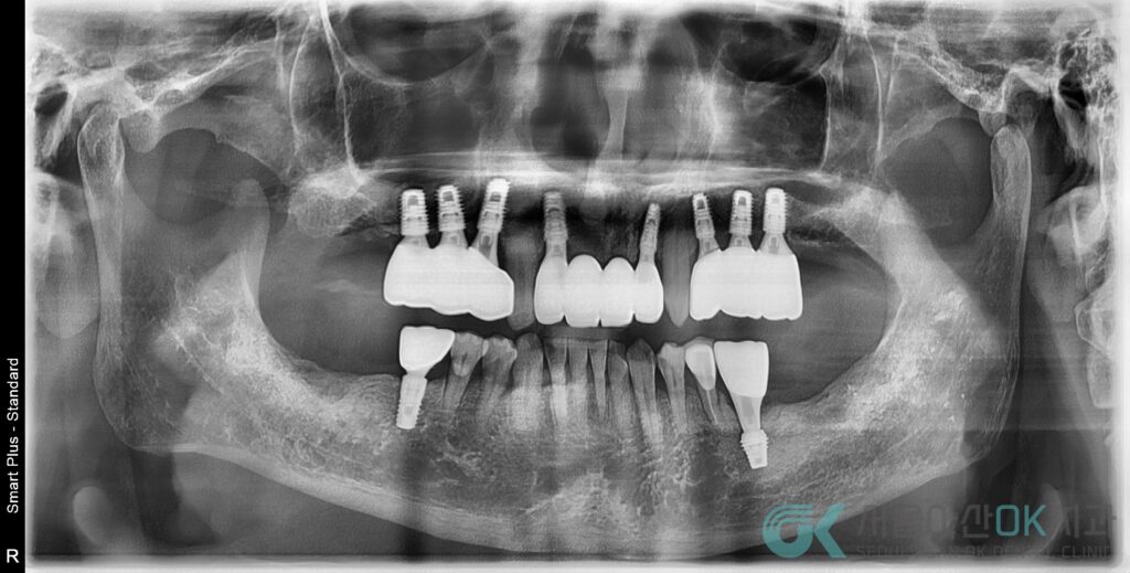 하남미사임플란트 치과, 잇몸이 약해도 임플란트치료가 가능한 이유 5