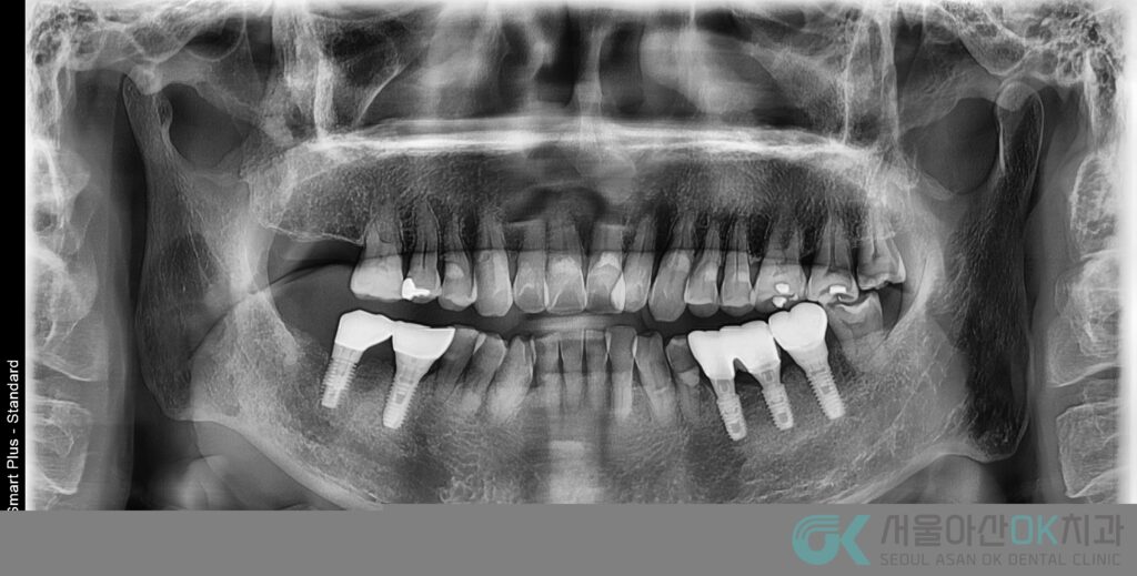 고혈압 환자도 안전하게 미사역 임플란트 받자! 8