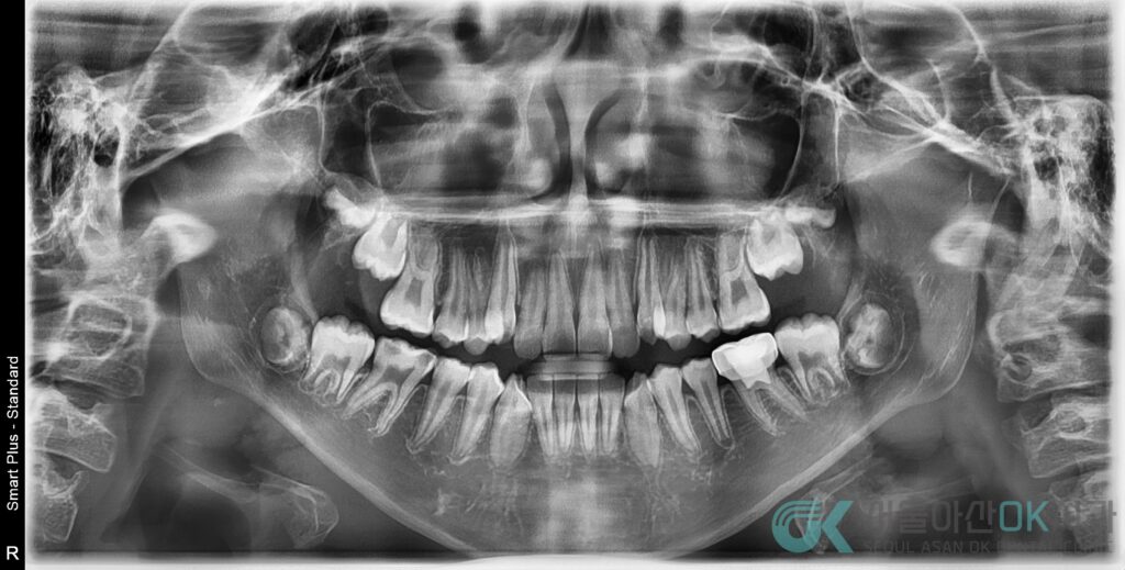 미사어린이치과, 심한 충치 신경치료가 필수일까? 2