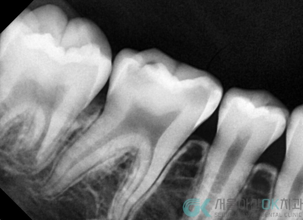 미사어린이치과, 심한 충치 신경치료가 필수일까? 3