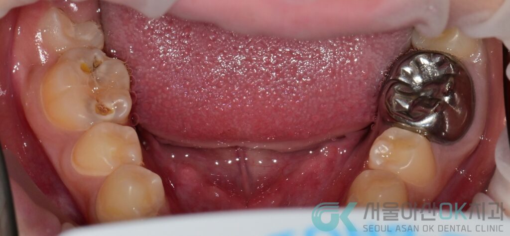 미사어린이치과, 심한 충치 신경치료가 필수일까? 4