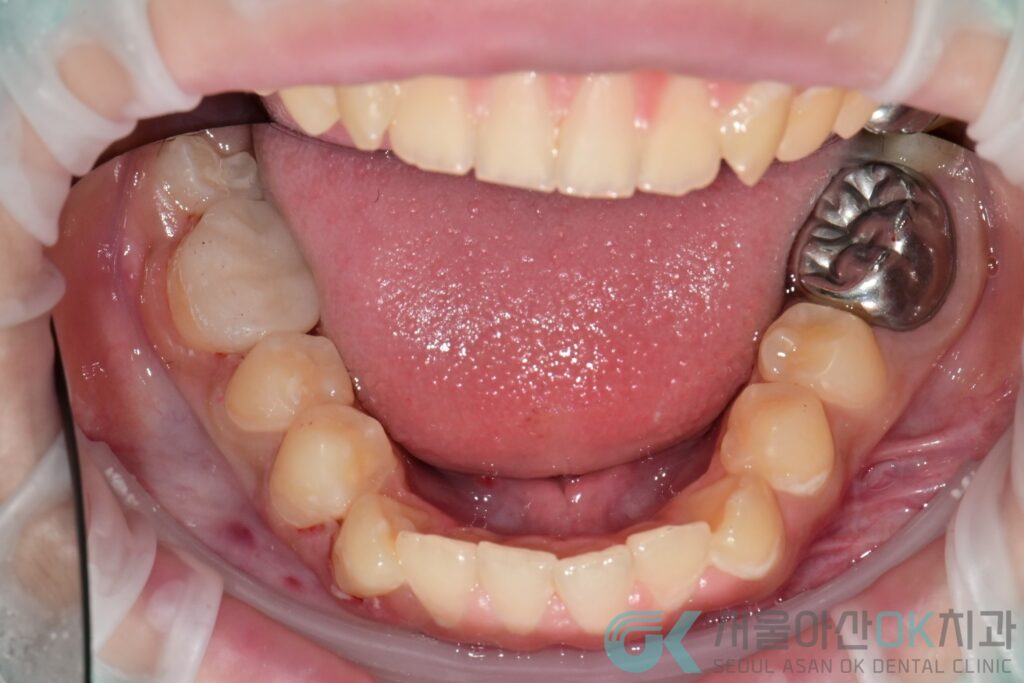 미사어린이치과, 심한 충치 신경치료가 필수일까? 5