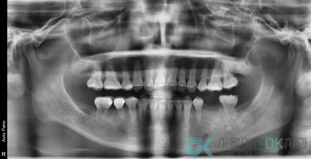 하남시 임플란트 뼈이식 기간, 급속골이식(​I-GBR) 사례 5
