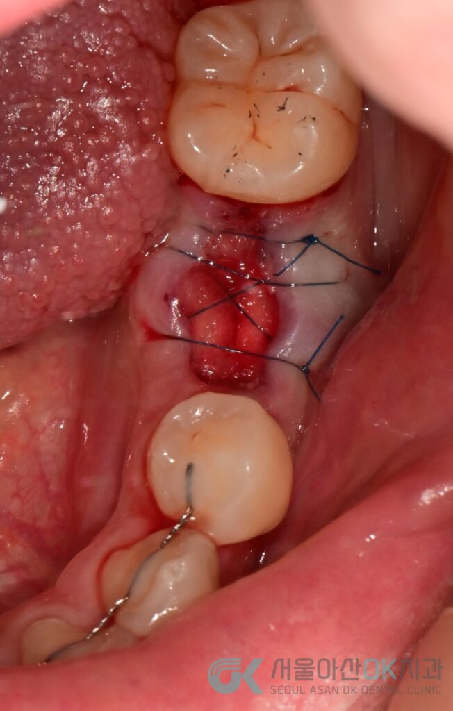 하남시 임플란트 뼈이식 기간, 급속골이식(​I-GBR) 사례 6