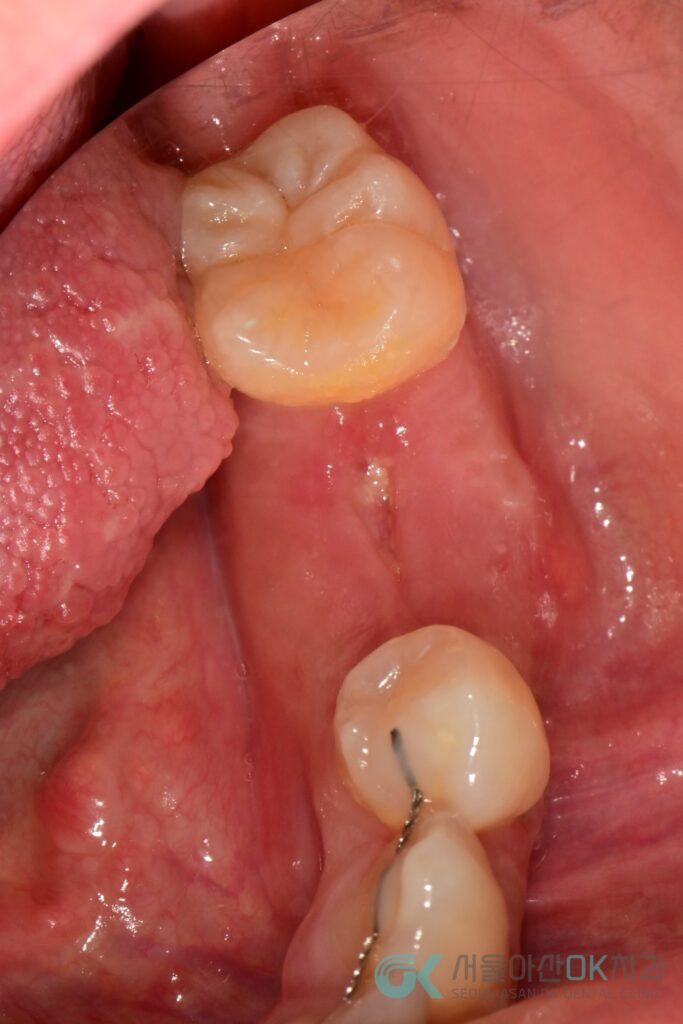 하남시 임플란트 뼈이식 기간, 급속골이식(​I-GBR) 사례 7
