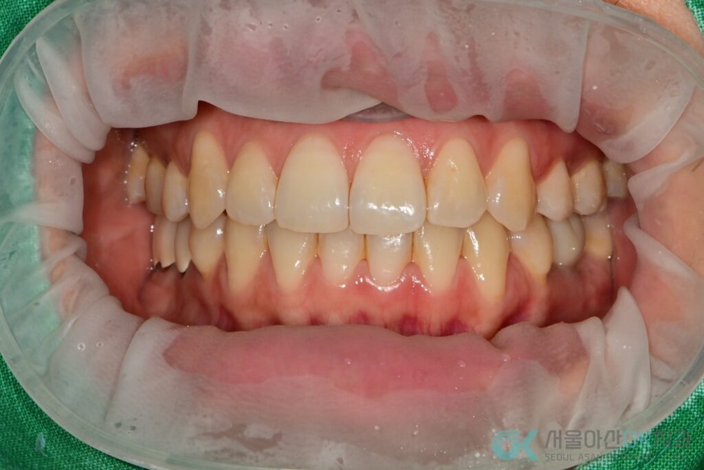 하남시 임플란트 뼈이식 기간, 급속골이식(​I-GBR) 사례 10