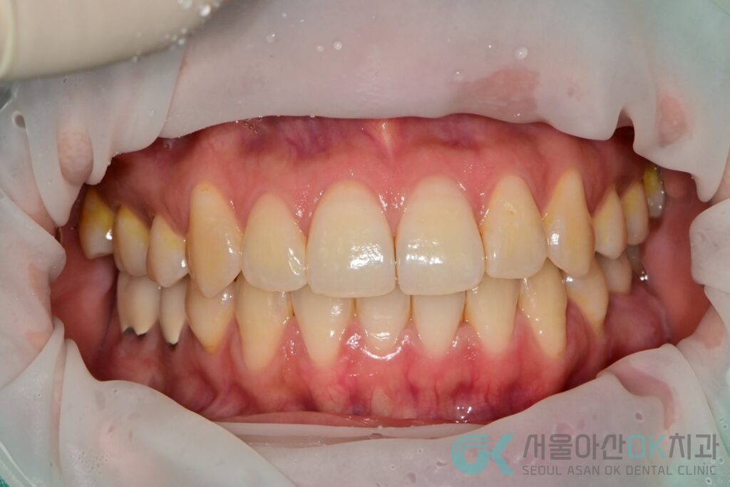 하남시 임플란트 뼈이식 기간, 급속골이식(​I-GBR) 사례 2