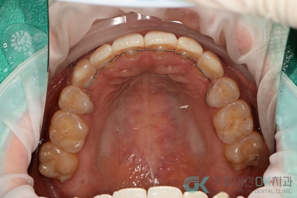 하남시 임플란트 뼈이식 기간, 급속골이식(​I-GBR) 사례 3