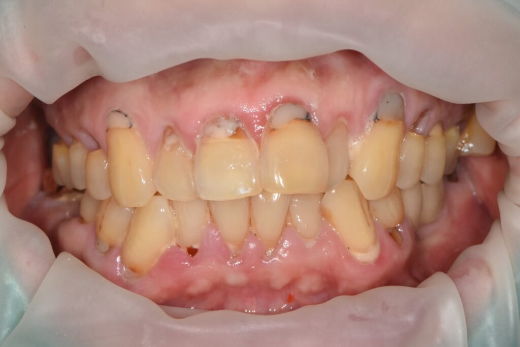 고혈압 환자도 안전하게 미사역 임플란트 받자! 2