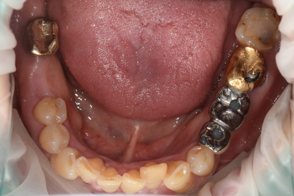 고혈압 환자도 안전하게 미사역 임플란트 받자! 3