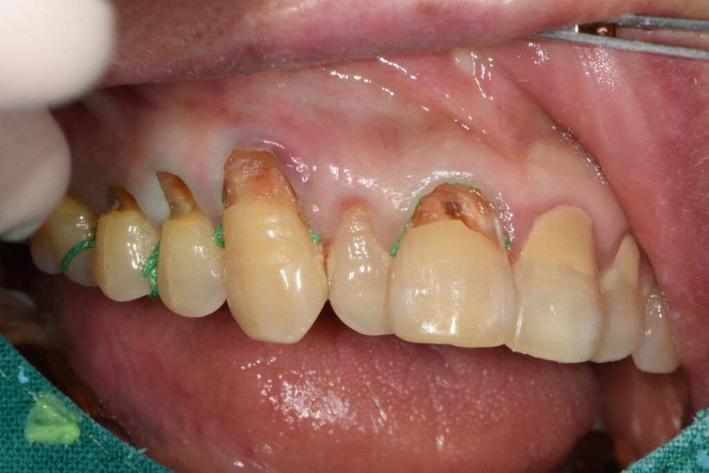 고혈압 환자도 안전하게 미사역 임플란트 받자! 6