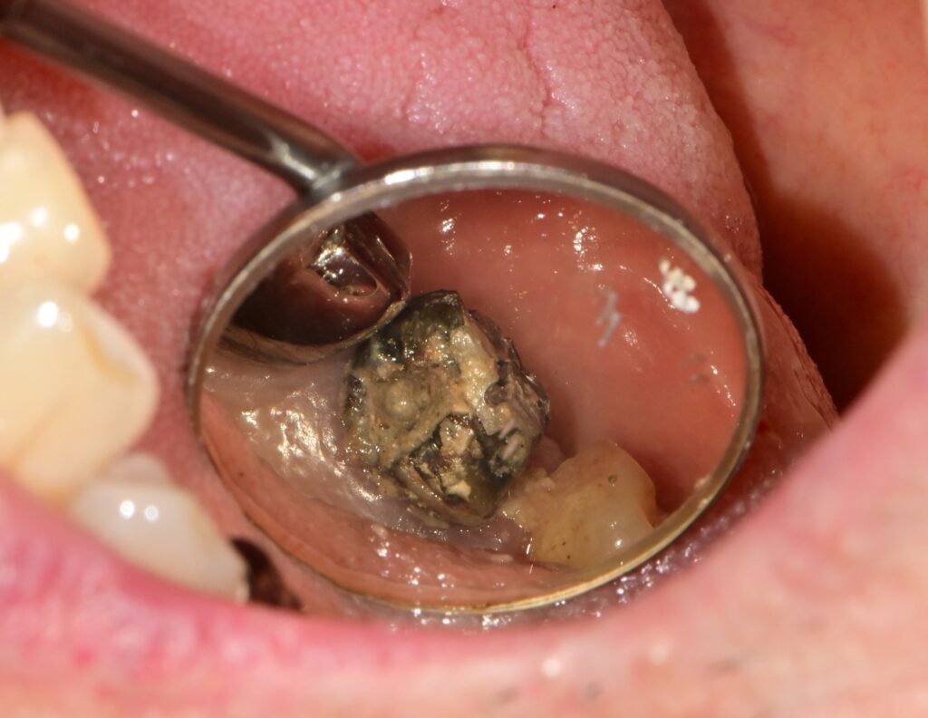 고혈압 환자도 안전하게 미사역 임플란트 받자! 4