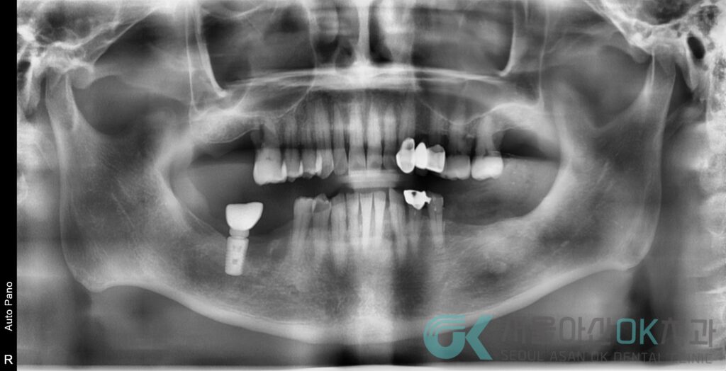 강동구임플란트치과, 신경치료부터 제대로! 4