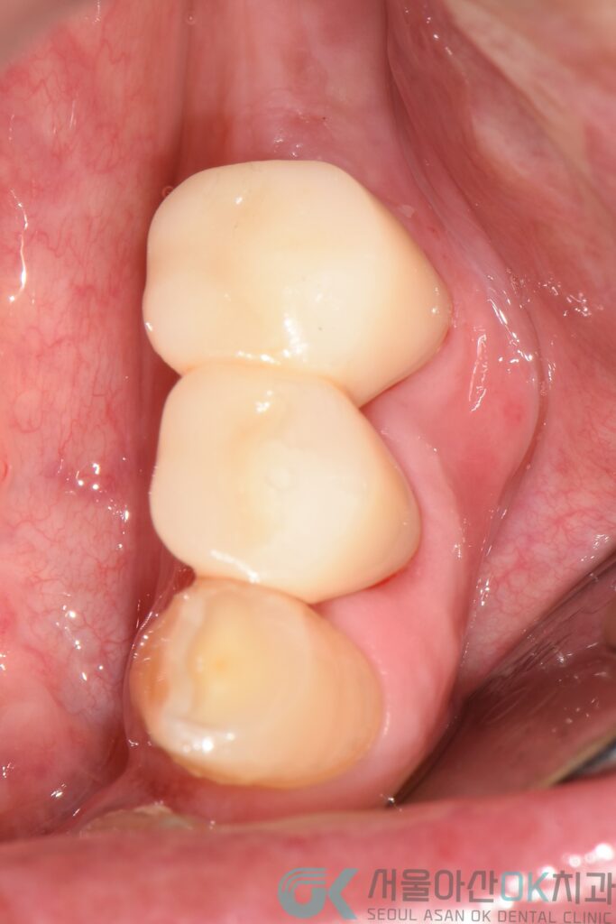 강동구임플란트치과, 신경치료부터 제대로! 7