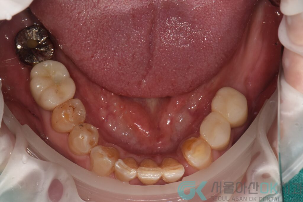 강동구임플란트치과, 신경치료부터 제대로! 5