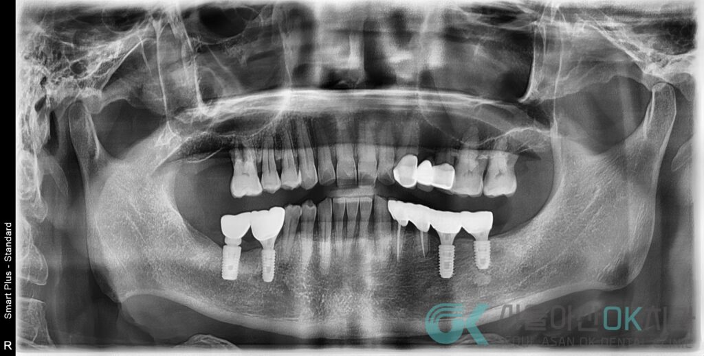 강동구임플란트치과, 신경치료부터 제대로! 8