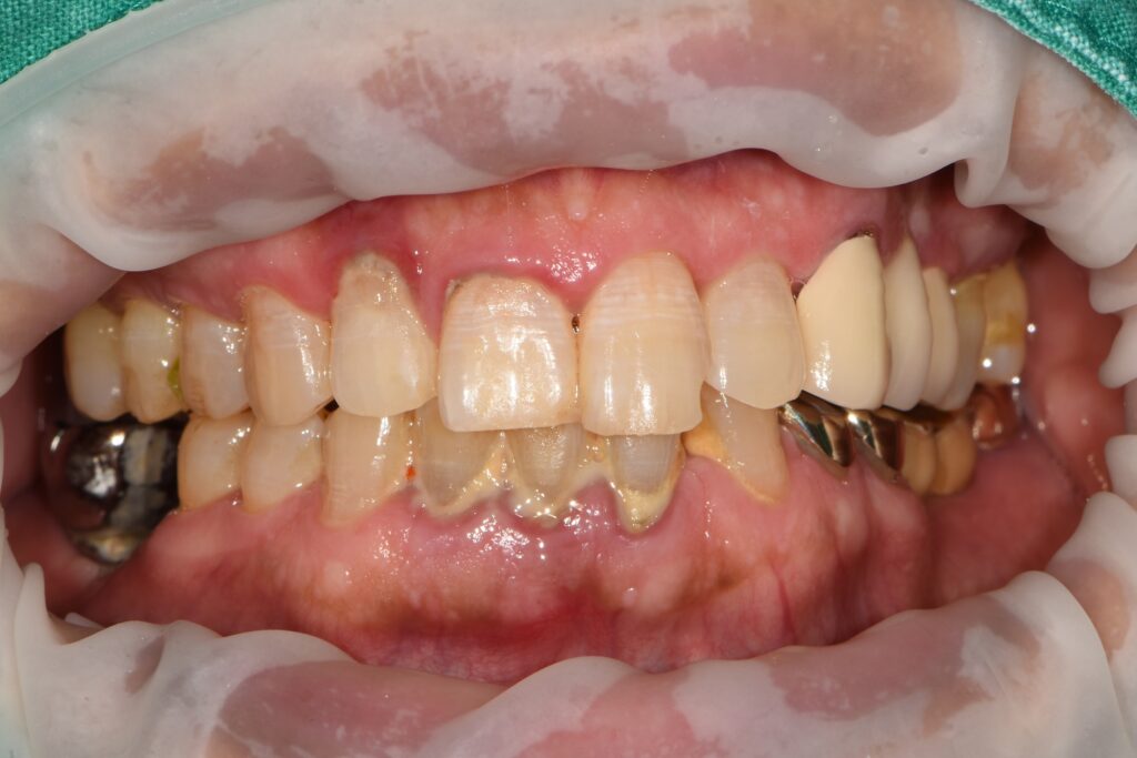 강동구임플란트치과, 신경치료부터 제대로! 3