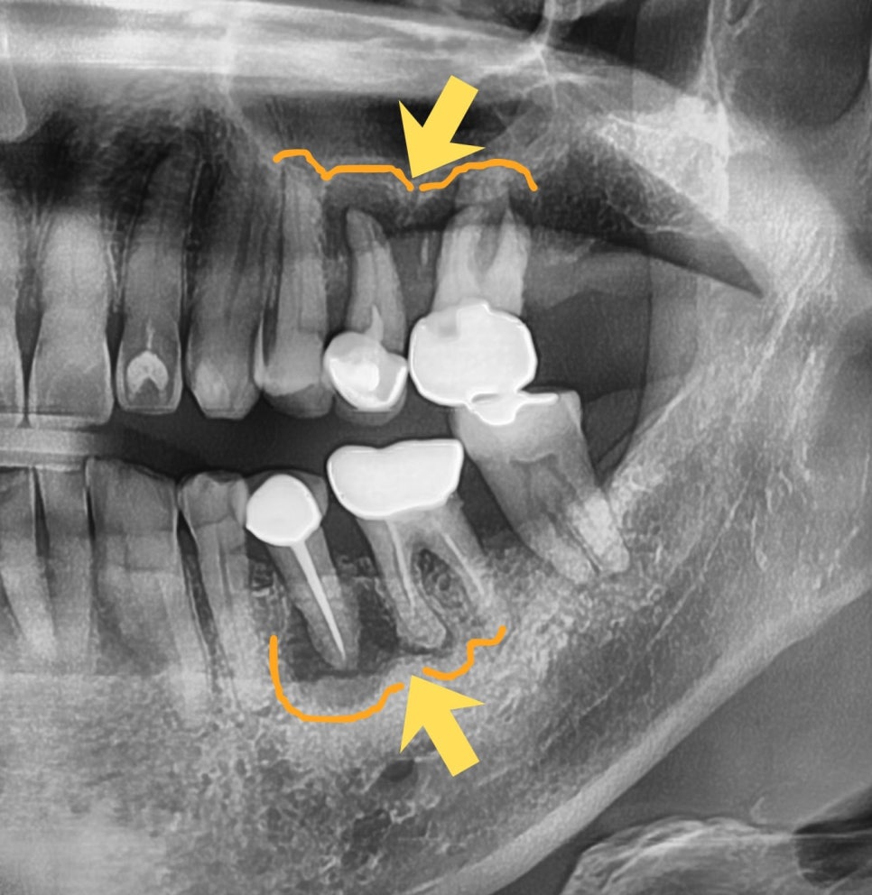 하남미사치과 임플란트, 뼈이식 권유 과잉진료일까요? <서울아산OK 대표원장 작성> 6
