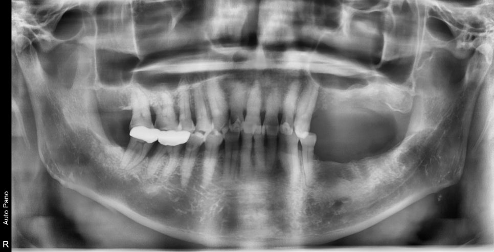 하남미사치과 임플란트, 뼈이식 권유 과잉진료일까요? <서울아산OK 대표원장 작성> 8