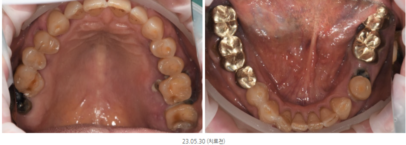 미사역치과 고령 임플란트, 당뇨·골다공증·뼈이식 이렇게 해결했습니다 <치주과 전문의 작성> 7