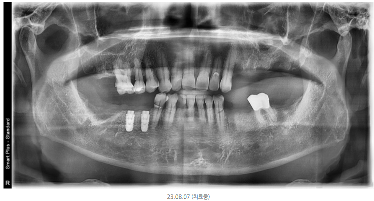 미사역치과 고령 임플란트, 당뇨·골다공증·뼈이식 이렇게 해결했습니다 <치주과 전문의 작성> 8