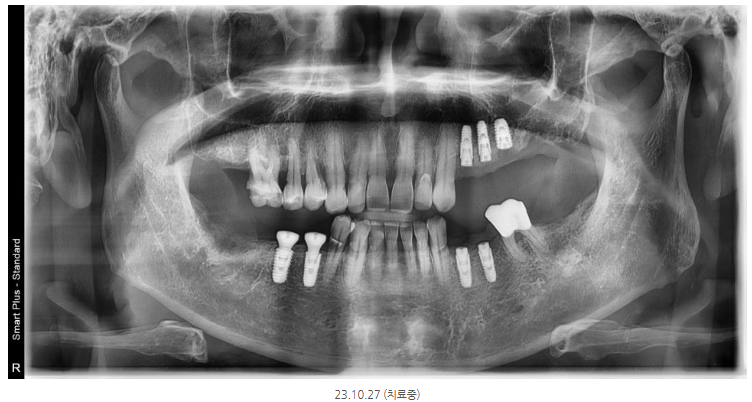 미사역치과 고령 임플란트, 당뇨·골다공증·뼈이식 이렇게 해결했습니다 <치주과 전문의 작성> 9