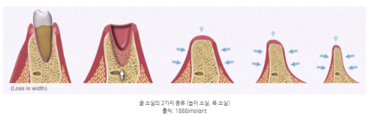 미사역치과 고령 임플란트, 당뇨·골다공증·뼈이식 이렇게 해결했습니다 <치주과 전문의 작성> 11