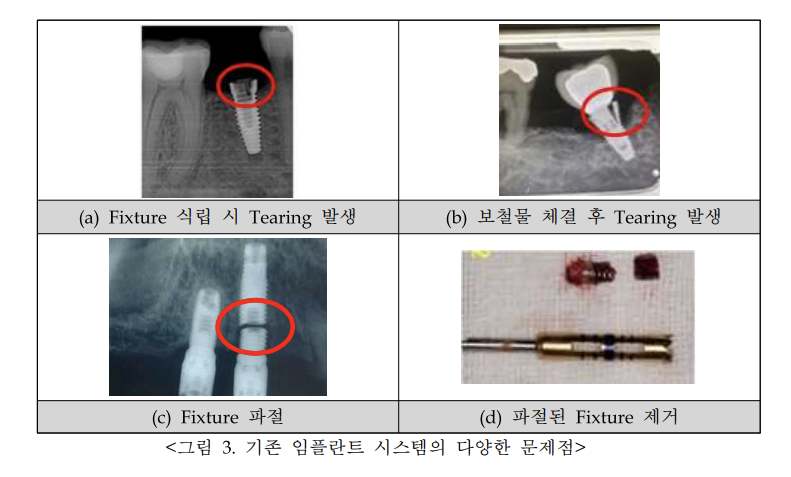미사 치과, 임플란트 39만원 정말 괜찮을까요? (비용·가격) 8