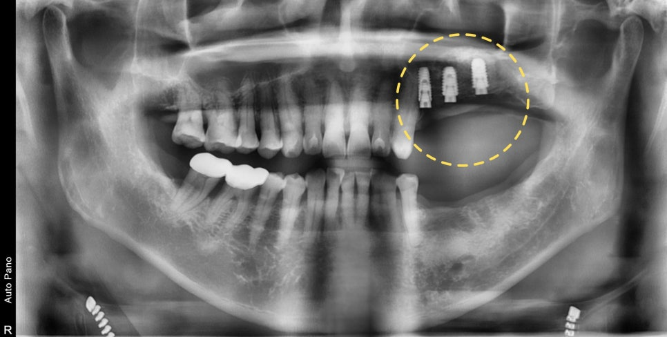 하남미사치과 임플란트, 뼈이식 권유 과잉진료일까요? <서울아산OK 대표원장 작성> 10