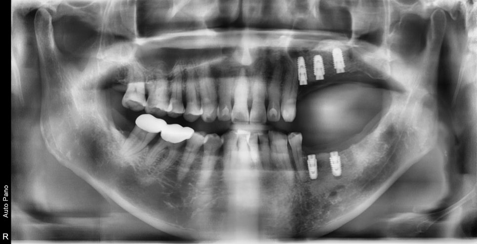 하남미사치과 임플란트, 뼈이식 권유 과잉진료일까요? <서울아산OK 대표원장 작성> 11
