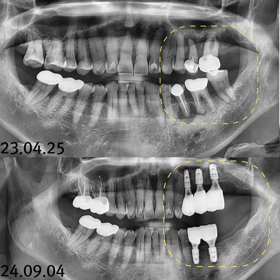 하남미사치과 임플란트, 뼈이식 권유 과잉진료일까요? <서울아산OK 대표원장 작성> 12