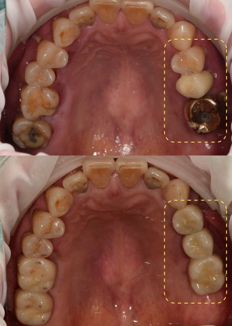 하남미사치과 임플란트, 뼈이식 권유 과잉진료일까요? <서울아산OK 대표원장 작성> 14