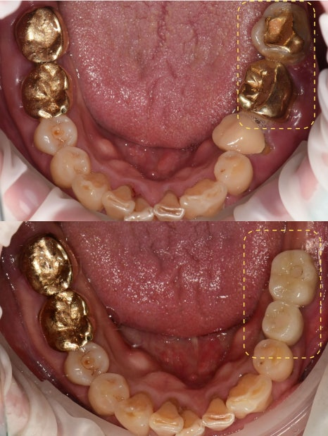 하남미사치과 임플란트, 뼈이식 권유 과잉진료일까요? <서울아산OK 대표원장 작성> 13