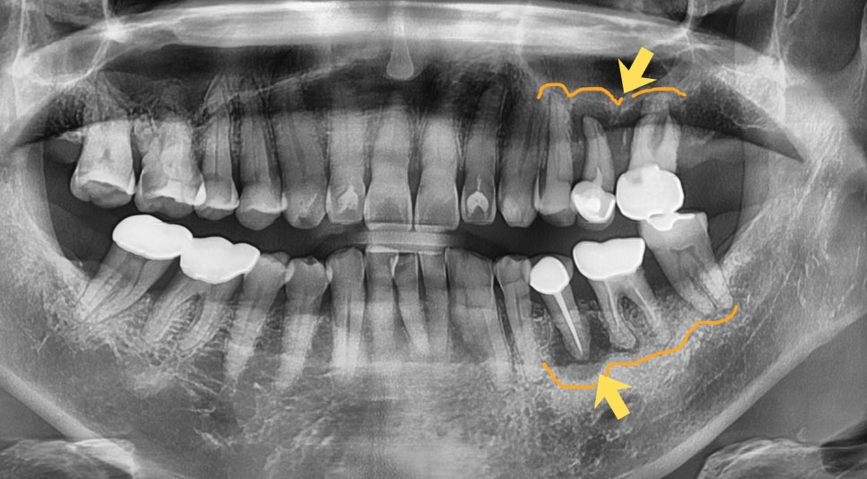 하남미사치과 임플란트, 뼈이식 권유 과잉진료일까요? <서울아산OK 대표원장 작성> 7