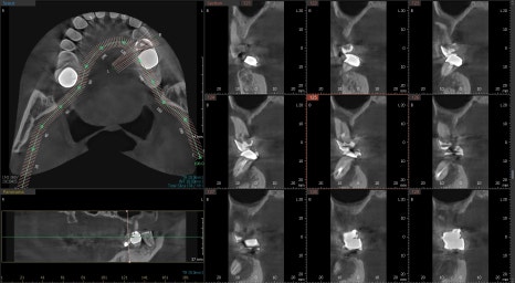 하남미사치과 임플란트, 뼈이식 권유 과잉진료일까요? <서울아산OK 대표원장 작성> 9
