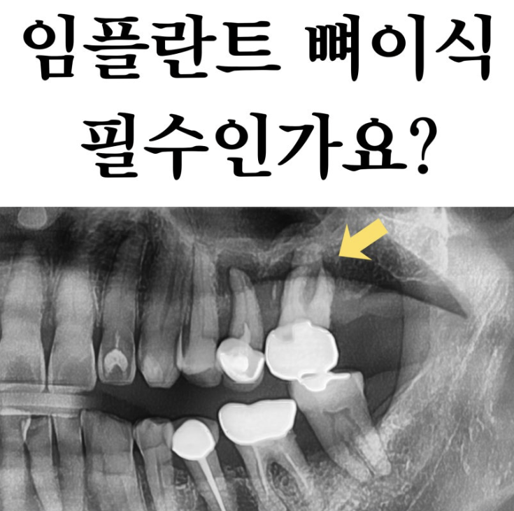 하남미사치과 임플란트, 뼈이식 권유 과잉진료일까요? <서울아산OK 대표원장 작성> 1