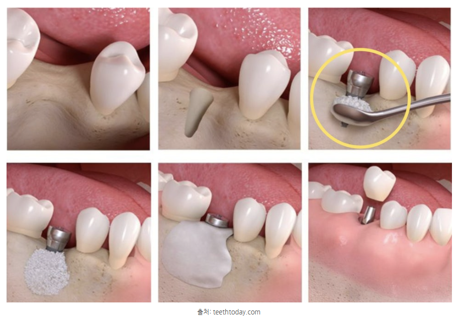 하남미사치과 임플란트, 뼈이식 권유 과잉진료일까요? <서울아산OK 대표원장 작성> 2