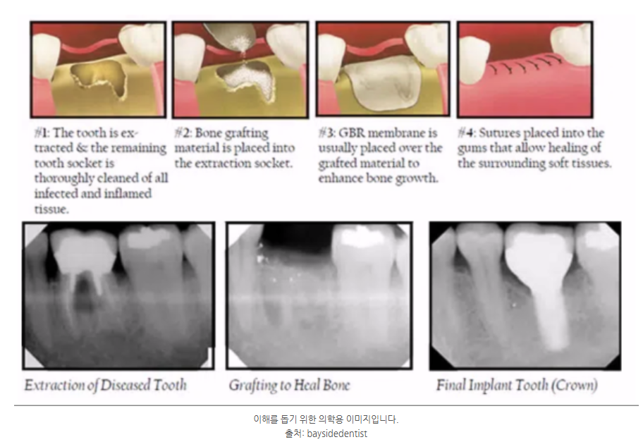 하남미사치과 임플란트, 뼈이식 권유 과잉진료일까요? <서울아산OK 대표원장 작성> 3