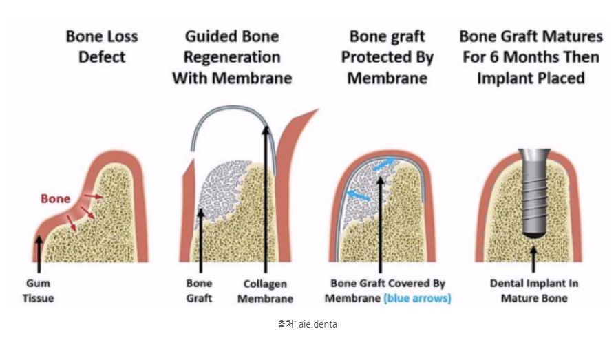 하남미사치과 임플란트, 뼈이식 권유 과잉진료일까요? <서울아산OK 대표원장 작성> 5