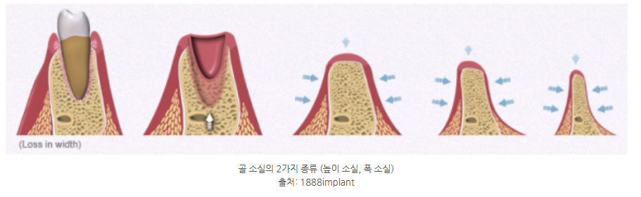 하남미사치과 임플란트, 뼈이식 권유 과잉진료일까요? <서울아산OK 대표원장 작성> 4