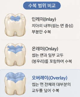 미사치과추천, 충치치료 치아 삭제 걱정된다면 읽어보세요 2 <의사조언> 4