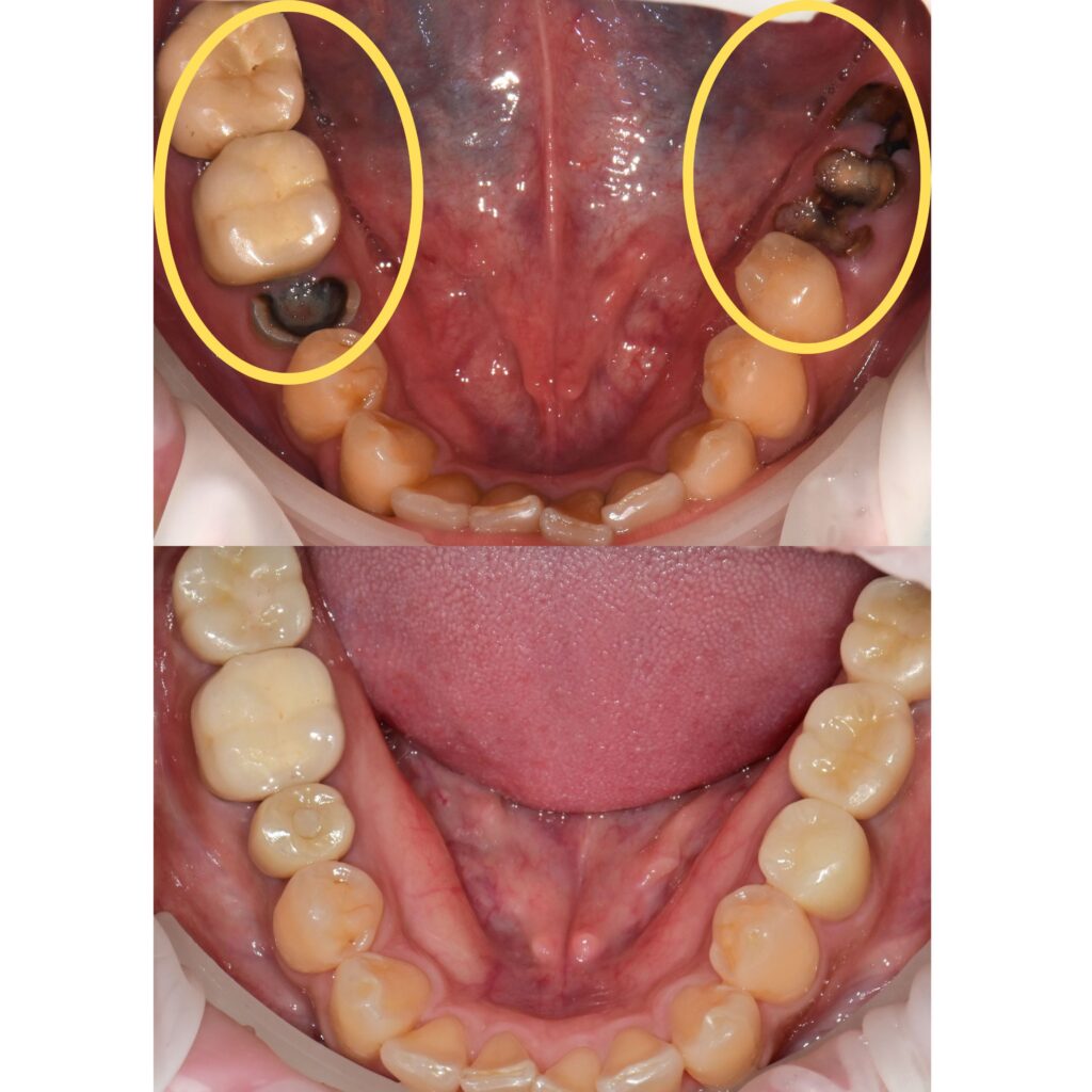 하남치과, 임플란트 가격 차이 왜 이렇게 날까요? <의사작성> 1