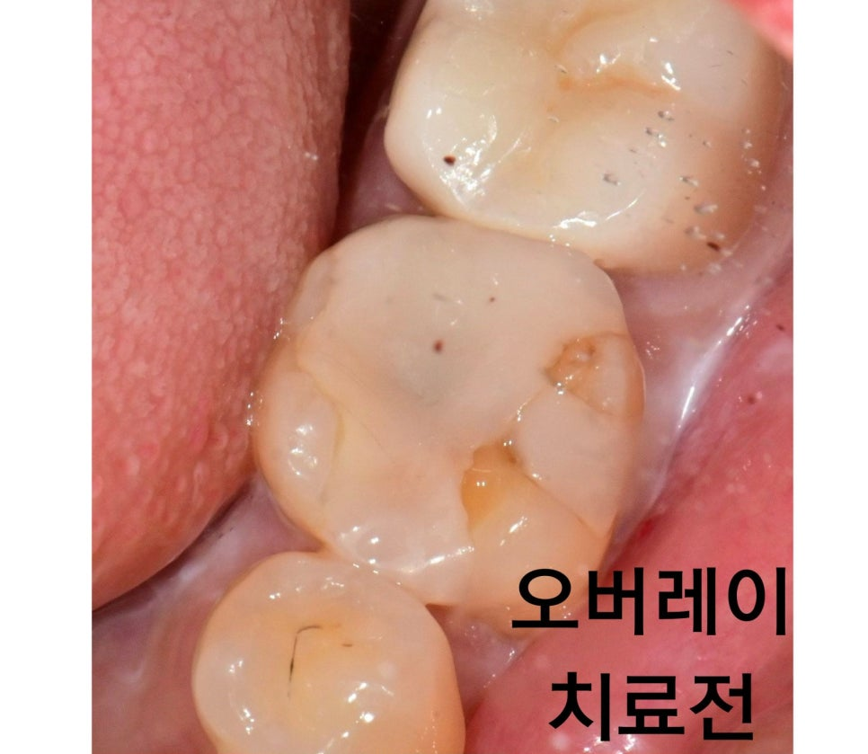 하남미사치과, 크라운 치료 시 치아 삭제량이 중요한 이유 <원장칼럼> 6