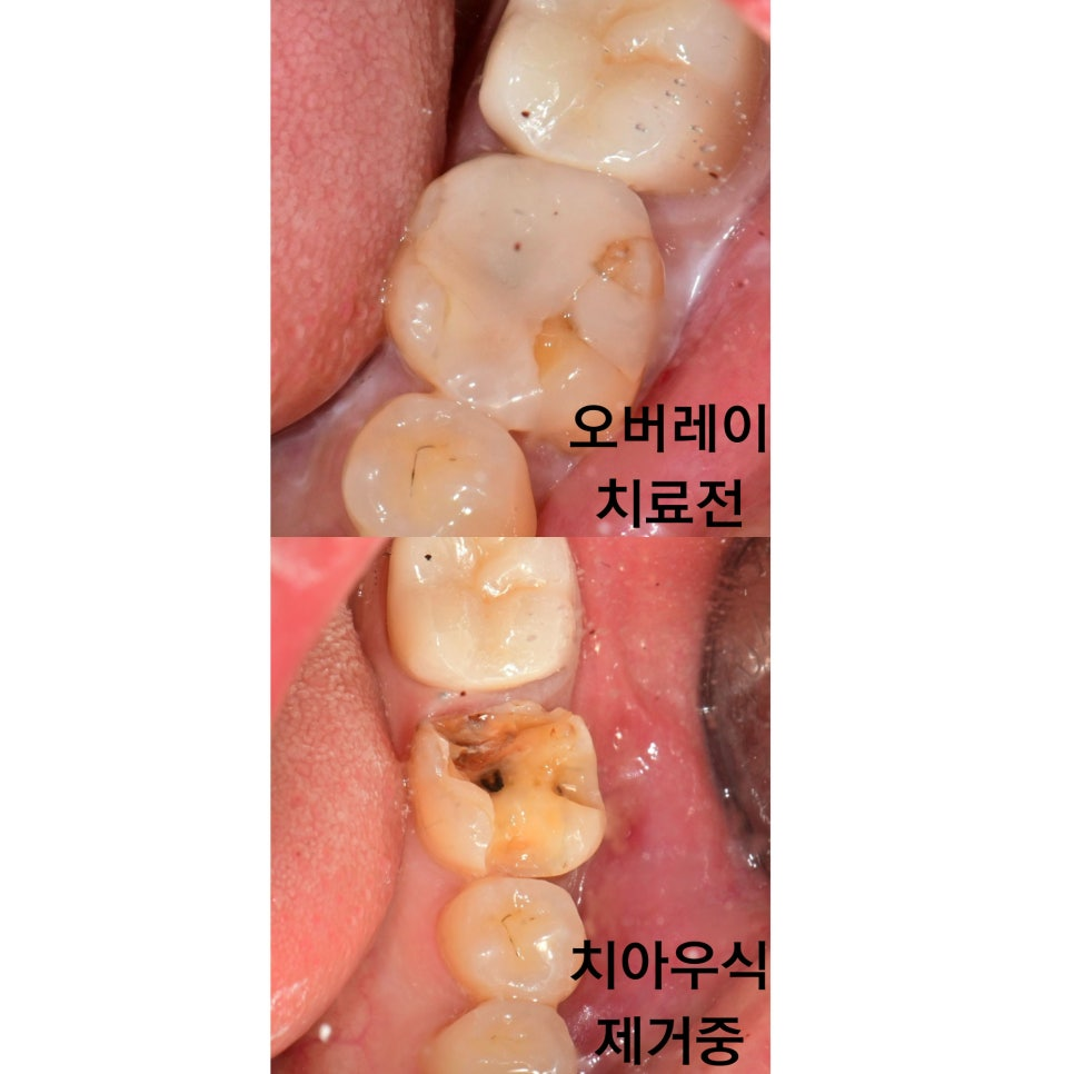 하남미사치과, 크라운 치료 시 치아 삭제량이 중요한 이유 <원장칼럼> 1