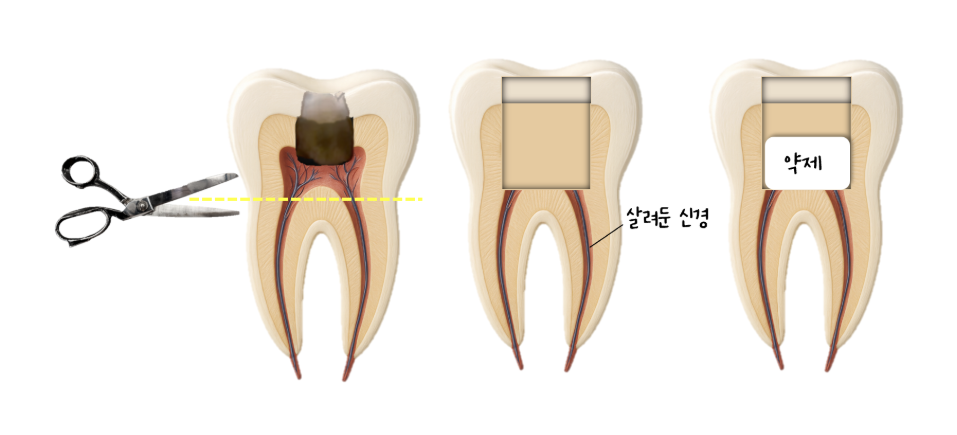 하남미사치과 충치치료, 충치가 깊다고 무조건 신경치료일까요? [대표원장 작성] 5