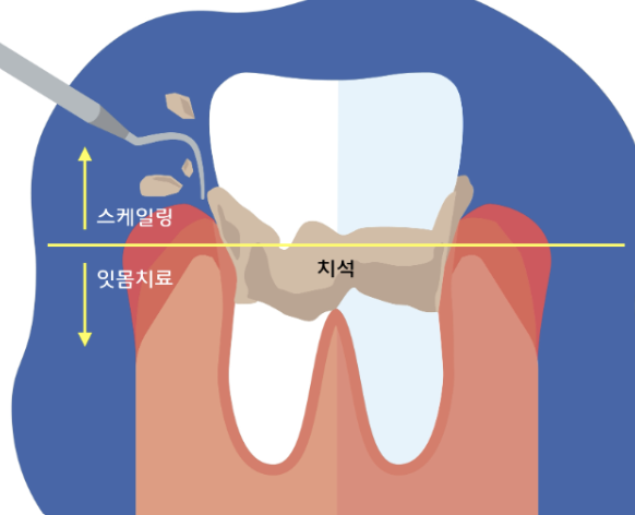 미사강변치과, 양치질할 때 잇몸에서 피가 난다면? 원인과 치료 방법 <대표원장 작성> 8