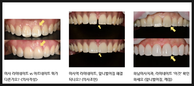 하남치과, 라미네이트 치아 삭제량은 어떻게 결정될까요? (아르네이트 사례) 9